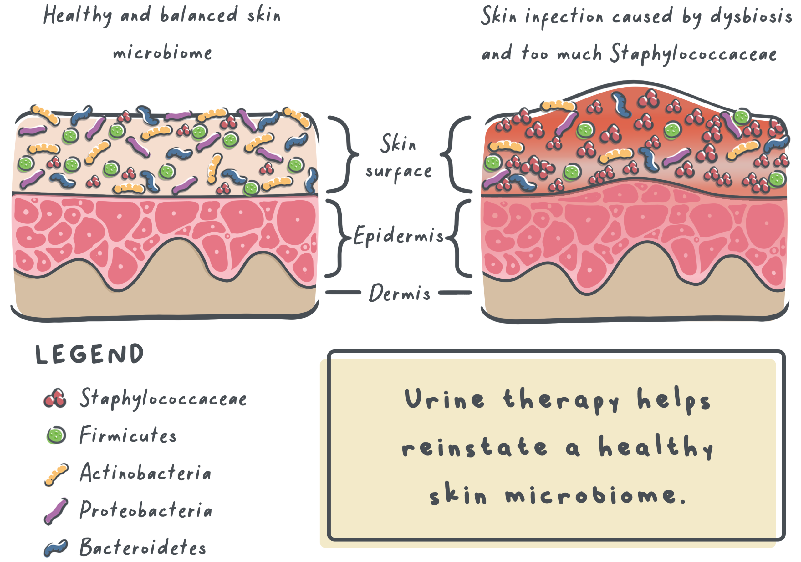 Progression from follicular occlusion and dilation to rupture and inflammatory nodules to a chronic state with sinus tracts and scarring